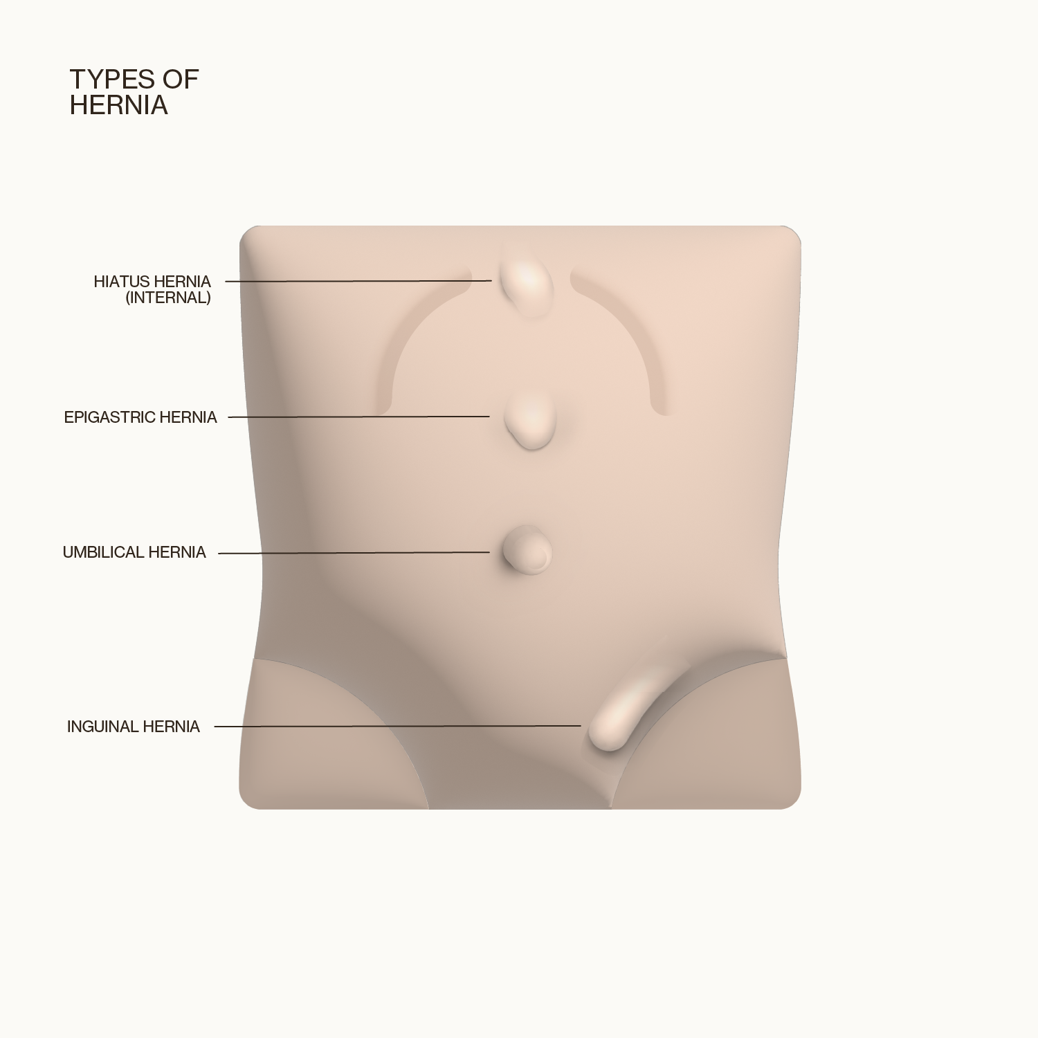 An illustration of four different hernia types including Hiatus Hernia, Epigastric Hernia (both in upper abdomen) and Umbilical and Inguinal Hernia, both in the lower abdomen/groin area.